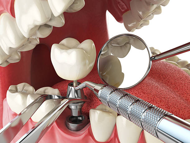 Best Knocked-Out Tooth Emergency  in Eclectic, AL